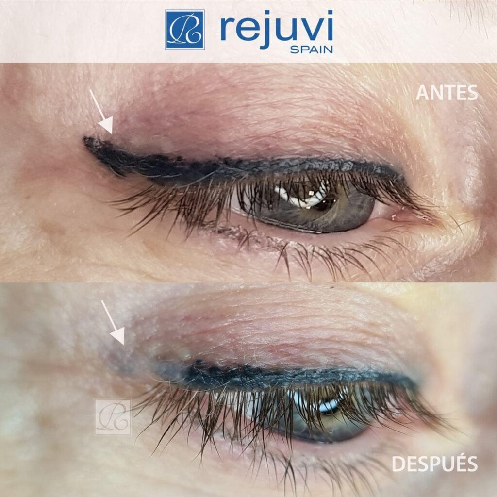 Eliminación de Micropigmentación sin Láser - Método Rejuvi 1 Antes y después del tratamiento de eliminación de micropigmentación de ojos eyliner con Rejuvi en centro Rocío Martín Micropigmentación y Estética Madrid