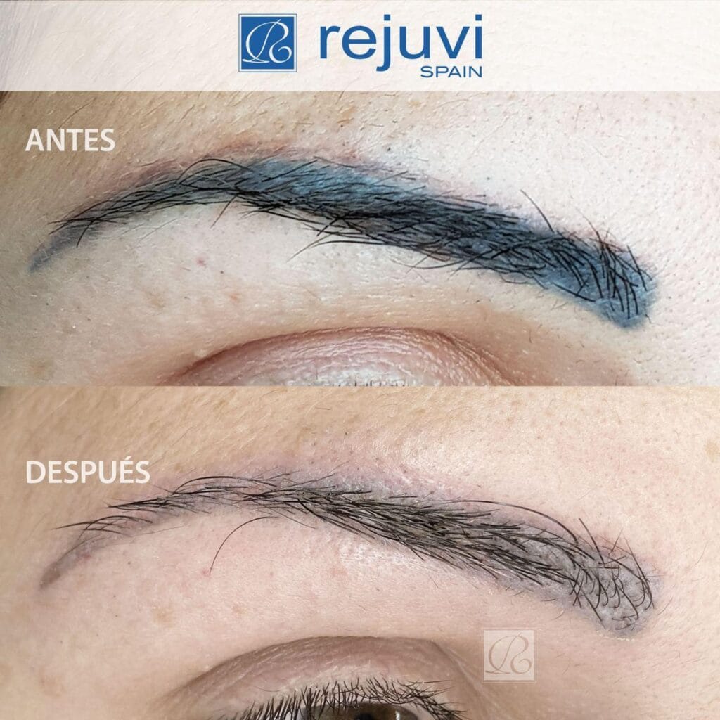Eliminación de Micropigmentación sin Láser - Método Rejuvi 2 Antes y después del tratamiento de eliminación de micropigmentación de labios con Rejuvi en centro Rocío Martín Micropigmentación y Estética Madrid