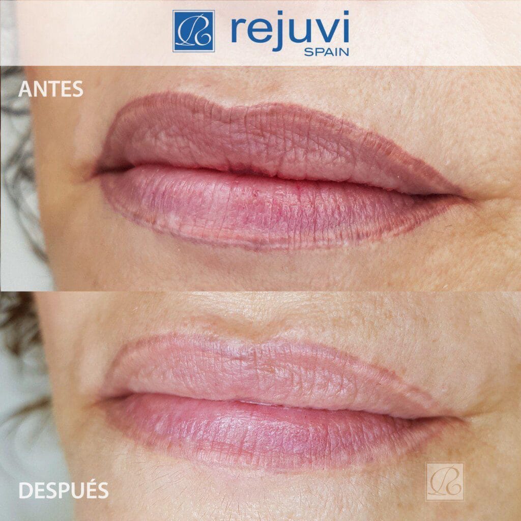 Eliminación de Micropigmentación sin Láser - Método Rejuvi 3 Antes y después del tratamiento de eliminación de micropigmentación de labios con Rejuvi en centro Rocío Martín Micropigmentación y Estética Madrid