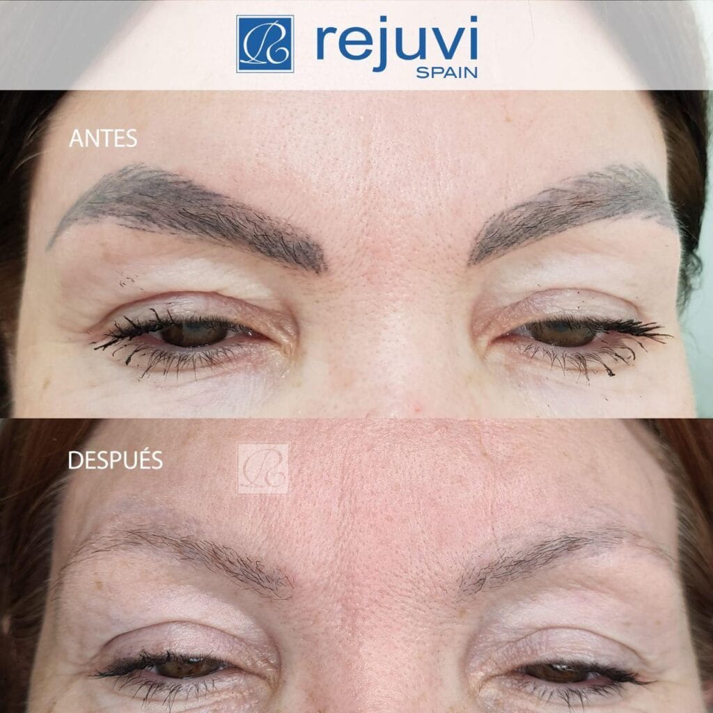 Eliminación de Micropigmentación sin Láser - Método Rejuvi 4 Antes y después del tratamiento de eliminación de micropigmentación en cejas con Rejuvi en centro Rocío Martín Micropigmentación y Estética Madrid