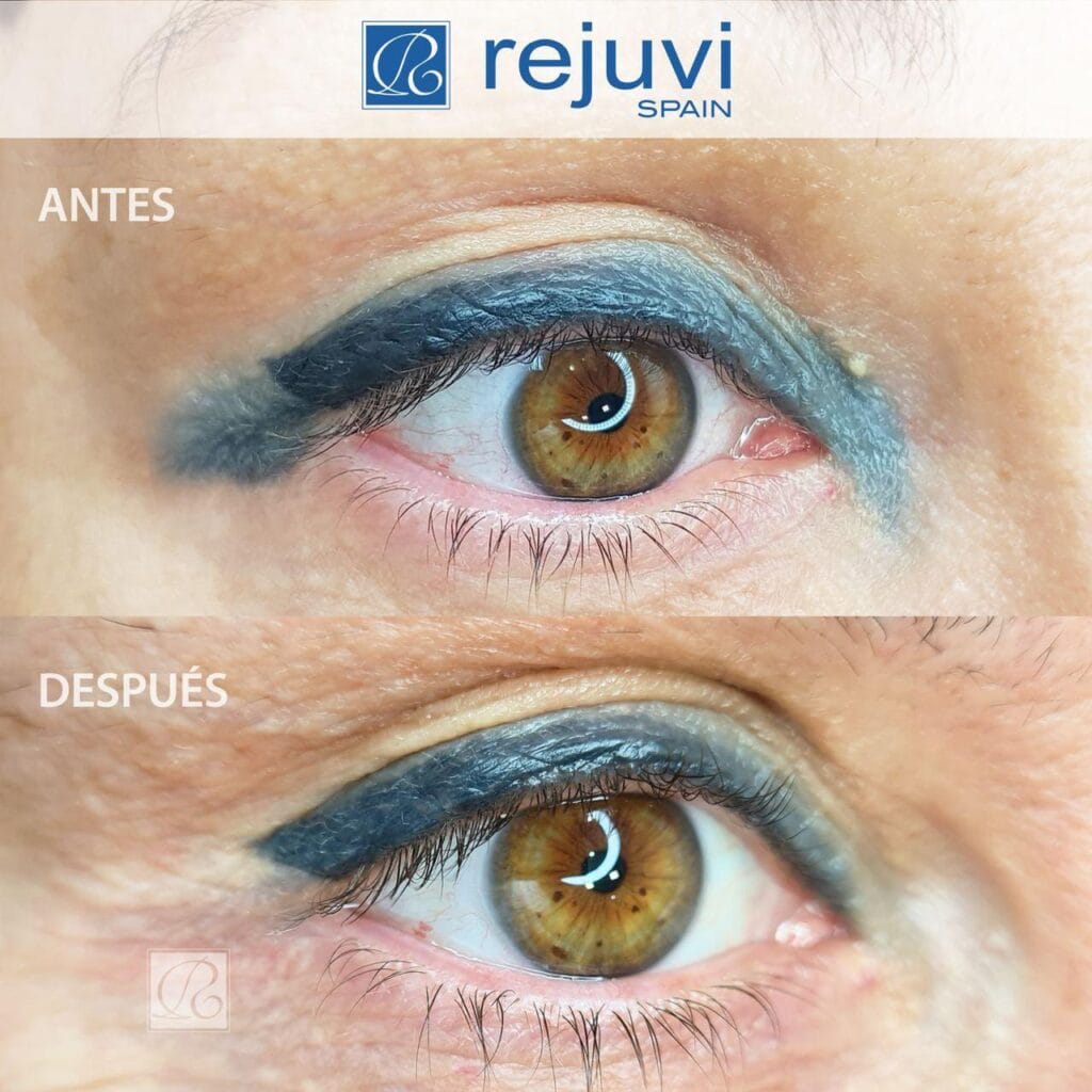 Eliminación de Micropigmentación sin Láser - Método Rejuvi 5 Antes y después del tratamiento de eliminación de micropigmentación de ojos eyliner con Rejuvi en centro Rocío Martín Micropigmentación y Estética Madrid