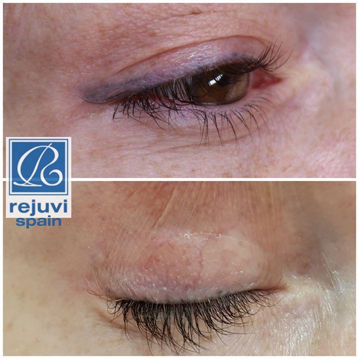 Eliminación de Micropigmentación sin Láser - Método Rejuvi 7 Antes y después del tratamiento de eliminación de micropigmentación de ojos eyliner con Rejuvi en centro Rocío Martín Micropigmentación y Estética Madrid