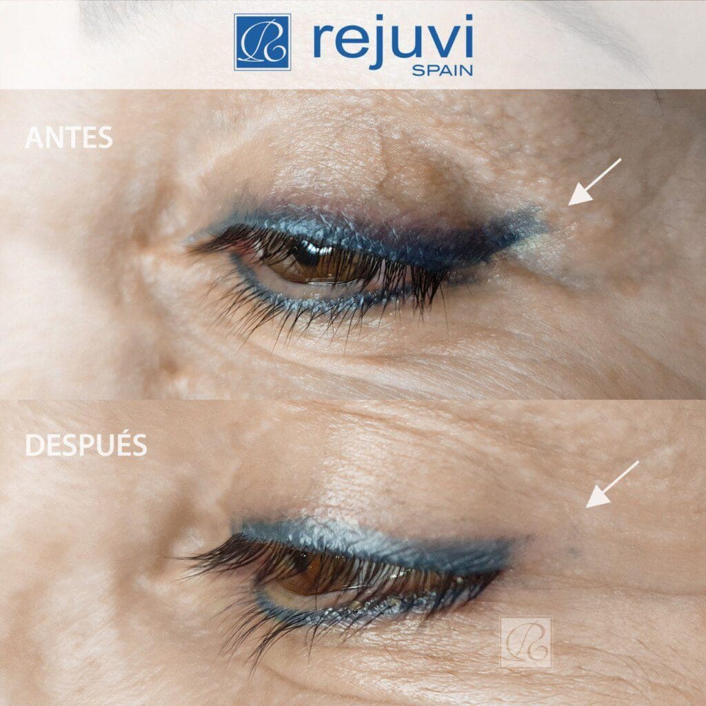 Eliminación de Micropigmentación sin Láser - Método Rejuvi 8 Antes y después del tratamiento de eliminación de micropigmentación de ojos eyliner con Rejuvi en centro Rocío Martín Micropigmentación y Estética Madrid