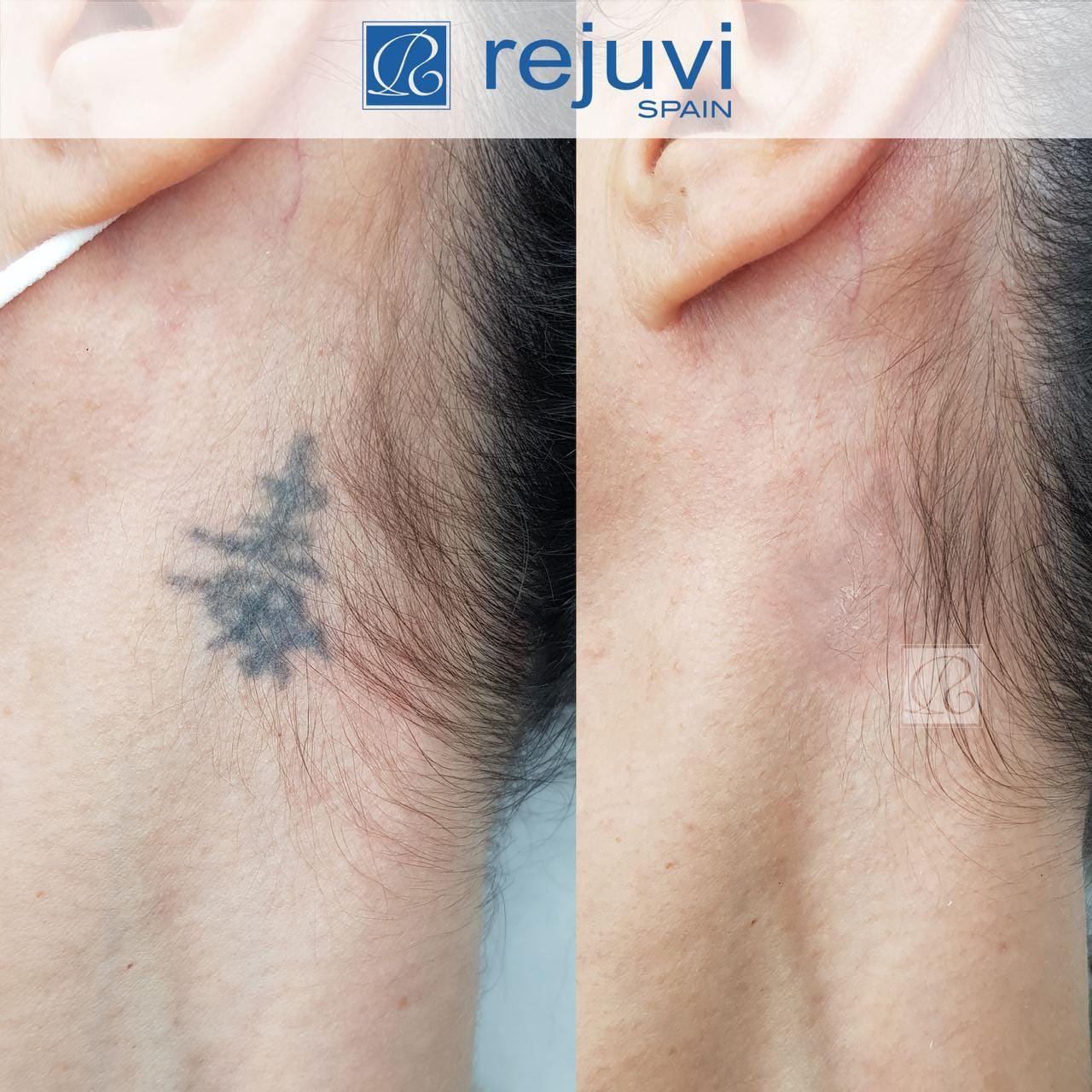 Eliminación de Micropigmentación sin Láser - Método Rejuvi 22 Proceso de resultados del tratamiento de eliminación de tatuaje pequeño con Rejuvi en centro Rocío Martín Micropigmentación y Estética Madrid