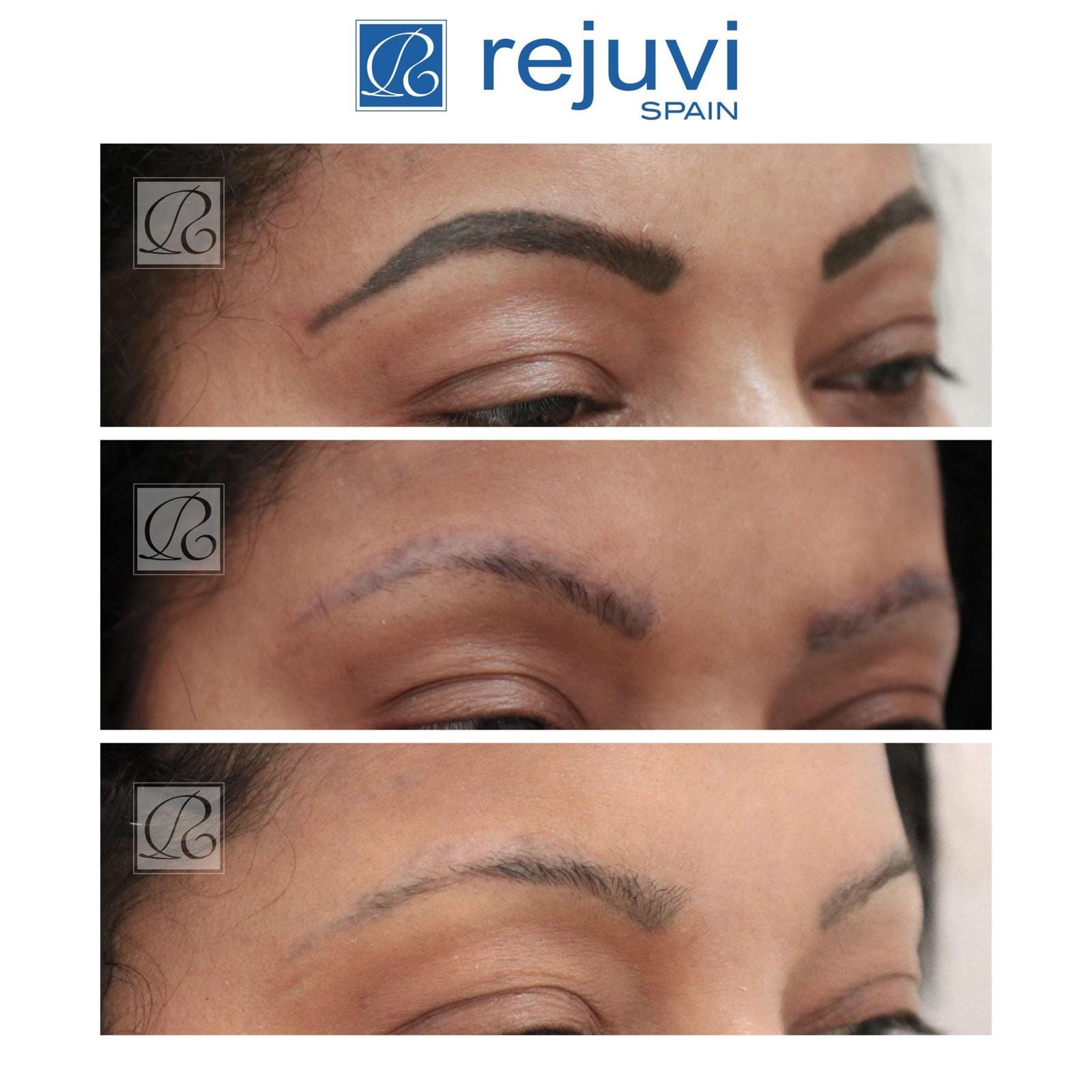Eliminación de Micropigmentación sin Láser - Método Rejuvi 9 Proceso de resultados del tratamiento de eliminación de micropigmentación en cejas con Rejuvi en centro Rocío Martín Micropigmentación y Estética Madrid