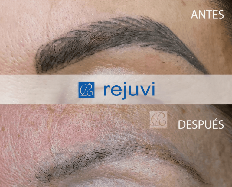 Antes y después de eliminación de micropigmentación en cejas con técnica Rejuvi en centro Rocío Martín Micropigmentación y Estética Madrid